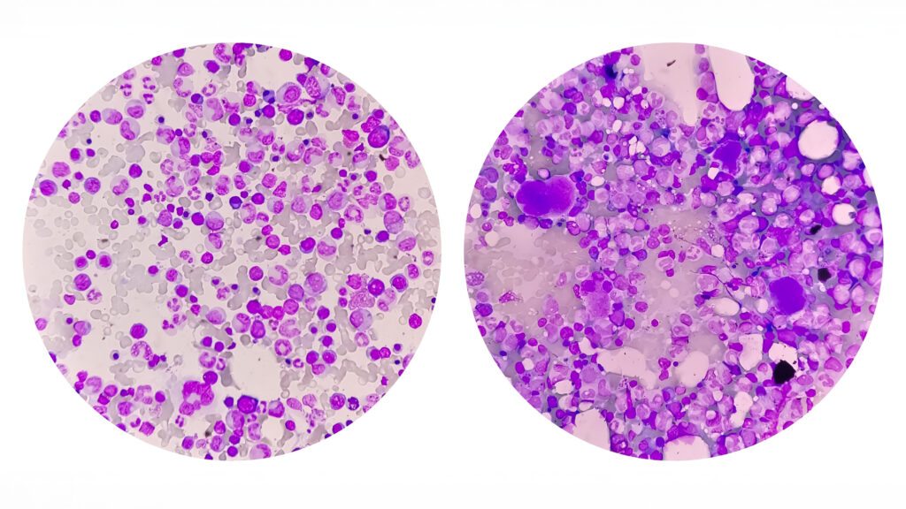 Comparison photomicrograph of bone marrow under a microscope, illustrating stem cell composition and aging effects. The left image shows healthy, youthful bone marrow with abundant hematopoietic stem cells, while the right image depicts aged bone marrow with diminished cellular density and increased signs of stem cell exhaustion. This visual represents the biological decline in regenerative capacity central to aging and longevity research.