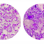 Comparison photomicrograph of bone marrow under a microscope, illustrating stem cell composition and aging effects. The left image shows healthy, youthful bone marrow with abundant hematopoietic stem cells, while the right image depicts aged bone marrow with diminished cellular density and increased signs of stem cell exhaustion. This visual represents the biological decline in regenerative capacity central to aging and longevity research.