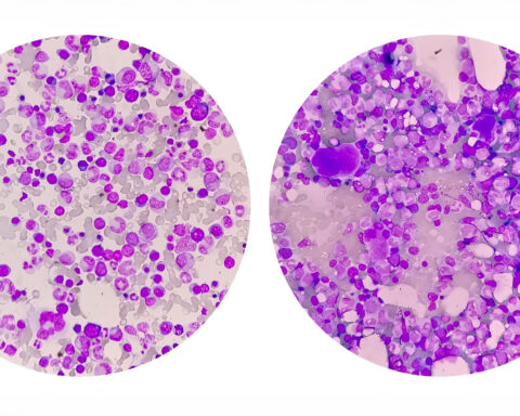 Comparison photomicrograph of bone marrow under a microscope, illustrating stem cell composition and aging effects. The left image shows healthy, youthful bone marrow with abundant hematopoietic stem cells, while the right image depicts aged bone marrow with diminished cellular density and increased signs of stem cell exhaustion. This visual represents the biological decline in regenerative capacity central to aging and longevity research.