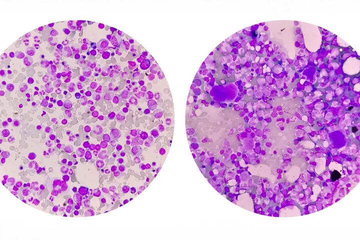 Comparison photomicrograph of bone marrow under a microscope, illustrating stem cell composition and aging effects. The left image shows healthy, youthful bone marrow with abundant hematopoietic stem cells, while the right image depicts aged bone marrow with diminished cellular density and increased signs of stem cell exhaustion. This visual represents the biological decline in regenerative capacity central to aging and longevity research.