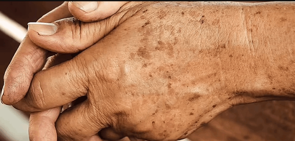 Close-up of an elderly hand clasped over the other, its weathered skin carrying a constellation of dark age spots across the knuckles and wrist. The fine lines and mottled pigment tell a quiet story of time, sun, and cellular change, a living canvas where lipofuscin’s presence makes itself visible as speckled marks of aging.