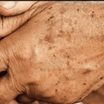 Close-up of an elderly hand clasped over the other, its weathered skin carrying a constellation of dark age spots across the knuckles and wrist. The fine lines and mottled pigment tell a quiet story of time, sun, and cellular change, a living canvas where lipofuscin’s presence makes itself visible as speckled marks of aging.