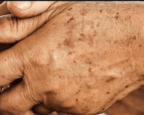 Close-up of an elderly hand clasped over the other, its weathered skin carrying a constellation of dark age spots across the knuckles and wrist. The fine lines and mottled pigment tell a quiet story of time, sun, and cellular change, a living canvas where lipofuscin’s presence makes itself visible as speckled marks of aging.