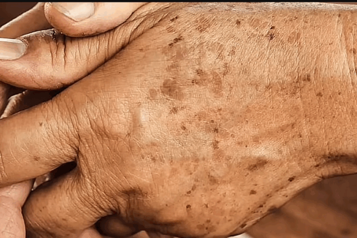 Close-up of an elderly hand clasped over the other, its weathered skin carrying a constellation of dark age spots across the knuckles and wrist. The fine lines and mottled pigment tell a quiet story of time, sun, and cellular change, a living canvas where lipofuscin’s presence makes itself visible as speckled marks of aging.